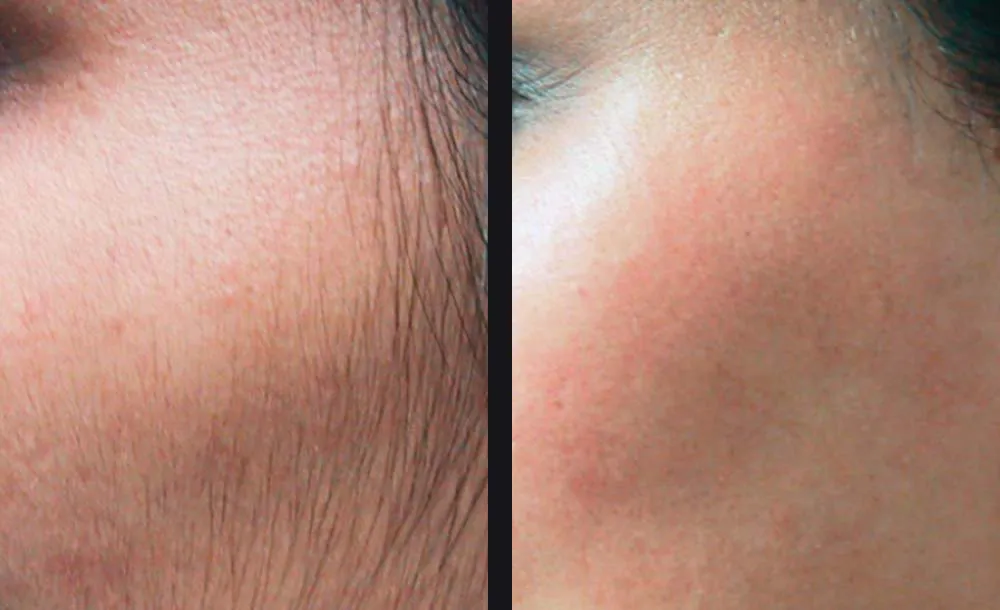 Before and after laser hair removal on the sideburn and cheek with the GentleMax Pro, before on the left and after on the right
