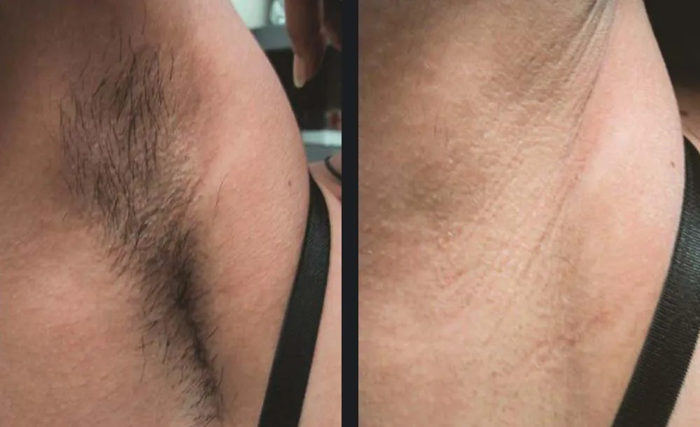 Before and after laser hair removal on the underarm with the GentleMax Pro, before on the left and after on the right