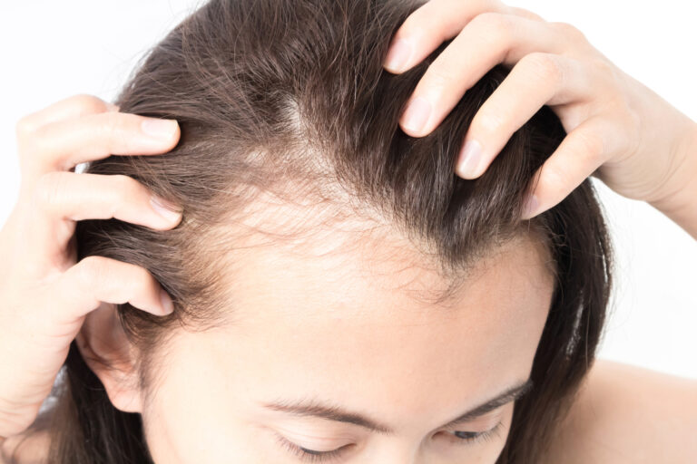 hair loss on scalp