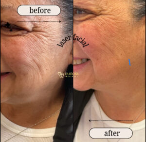 before and after of laser facial