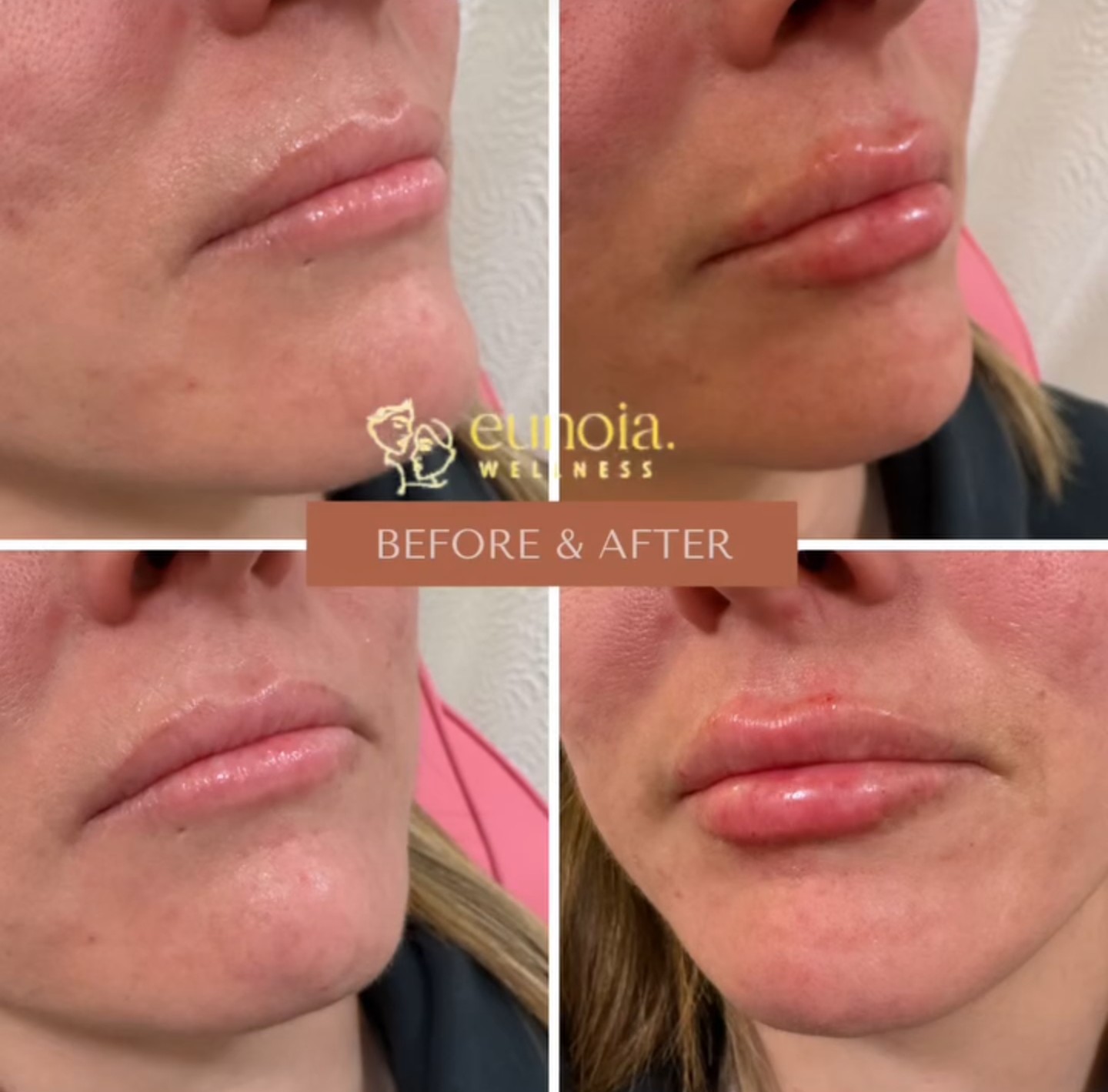 Dermal filler before and after result
