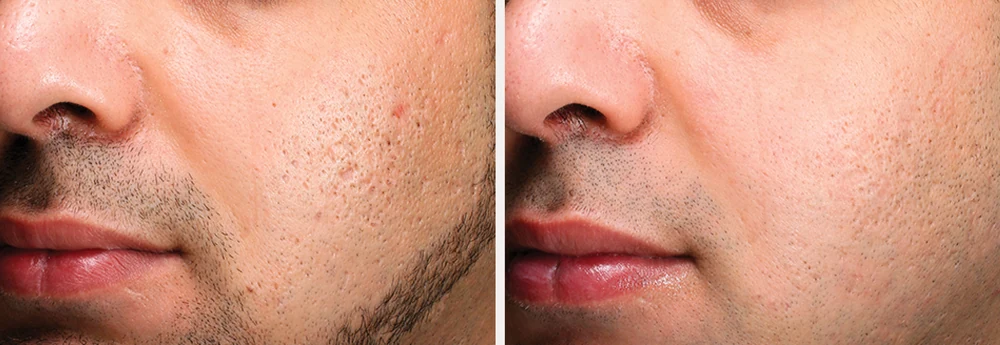 Exceed microneedling acne scar before and after results