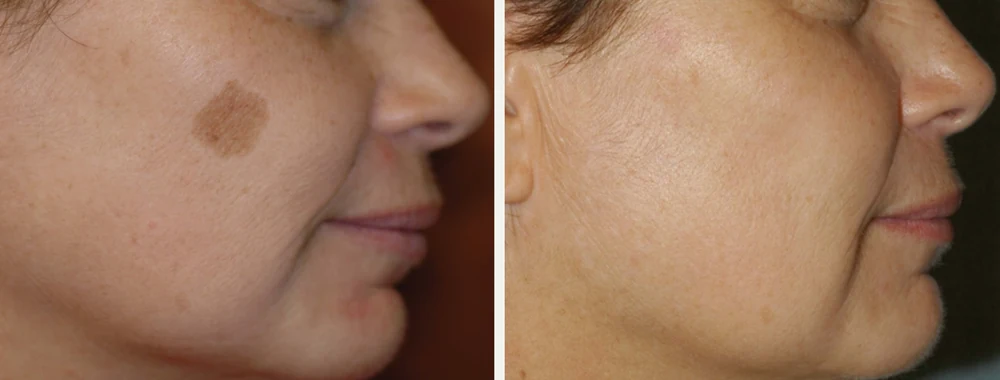GentleMax Pro before and after result