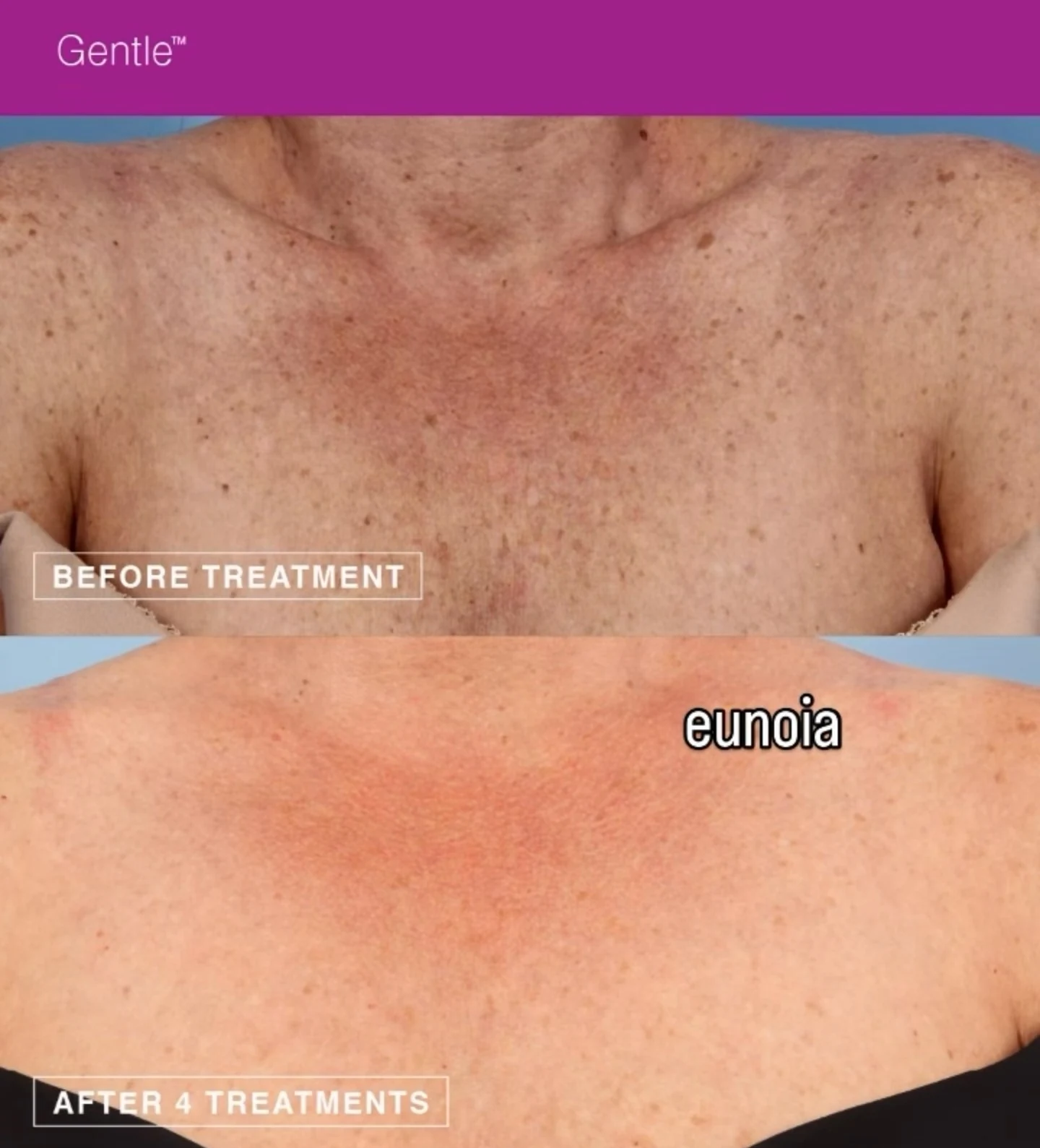 Brown spot removal before and after result