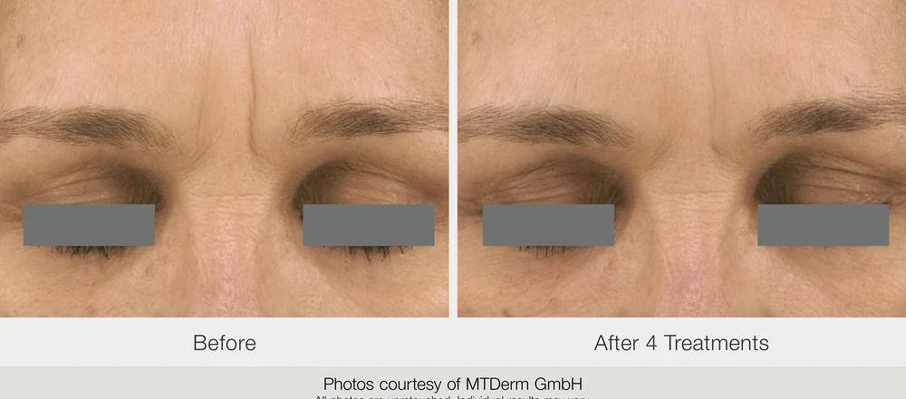 Exceed microneedling before and after result