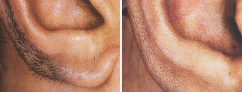 Laser hair removal before and after results