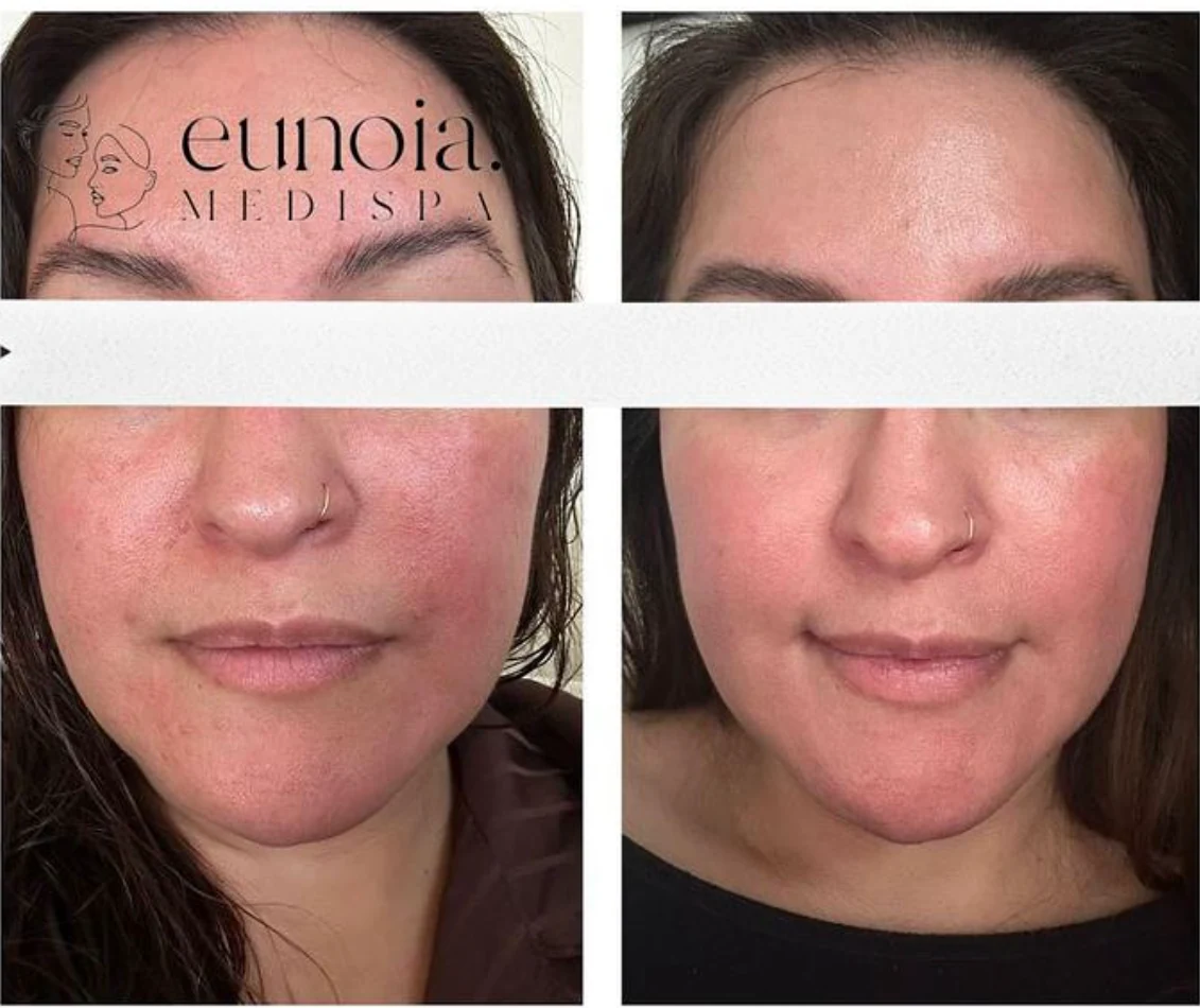 Rosacea IPL treatment before and after result