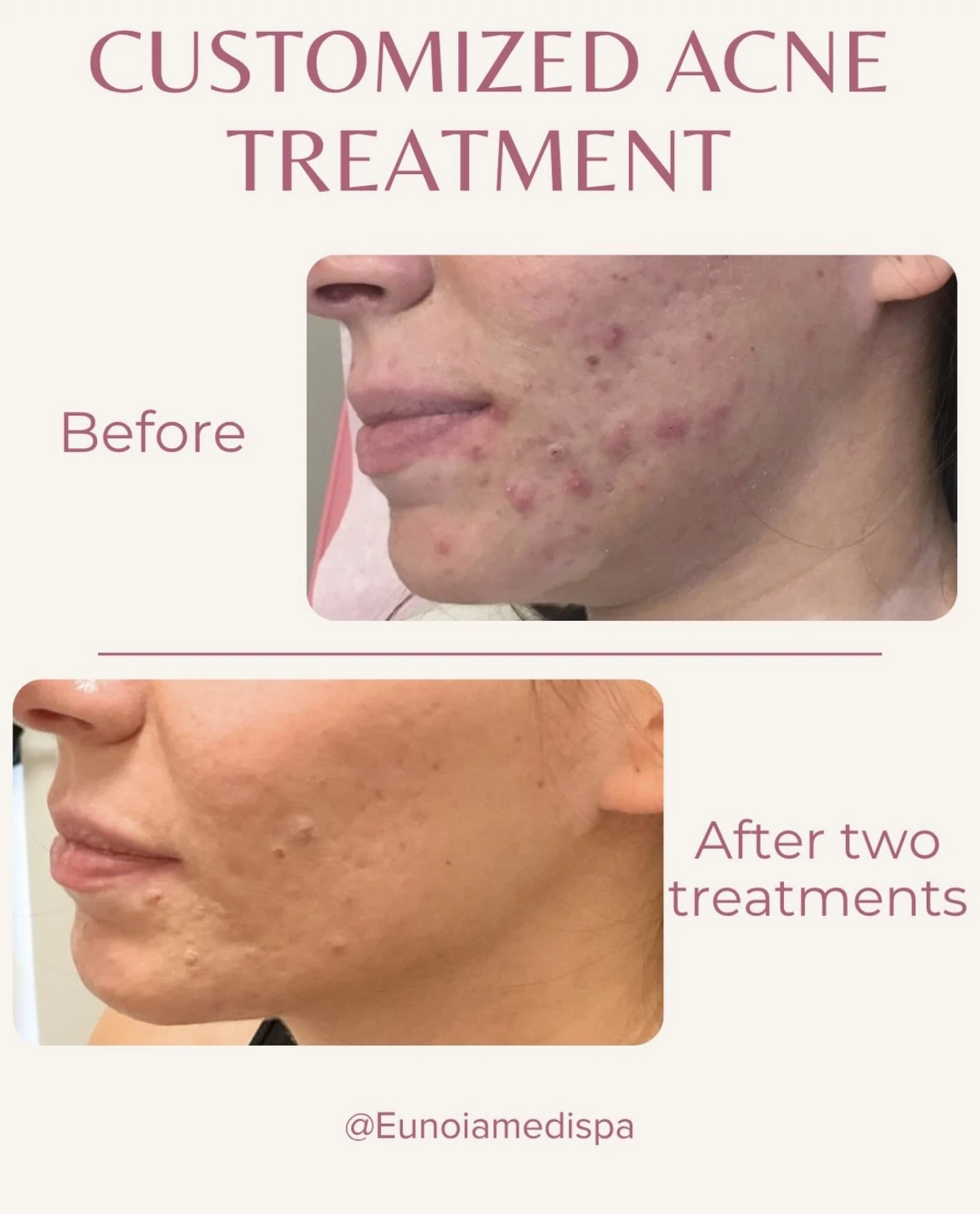 Customized acne treatment before and after result