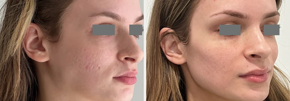 Nordlys before and after result