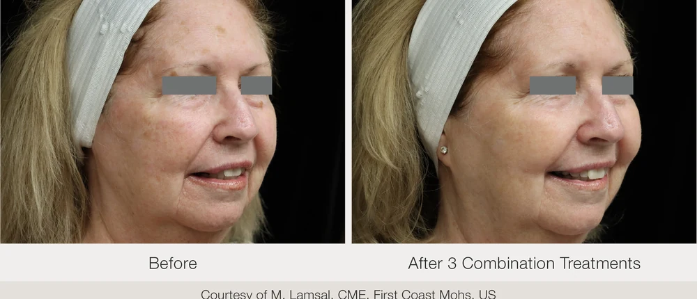 Nordlys brown spot and pigmentation before and after results