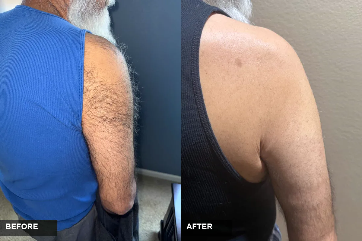 Before and after laser hair removal on the shoulder and upper arm at Eunoia Medi Spa, before on the left and after on the right