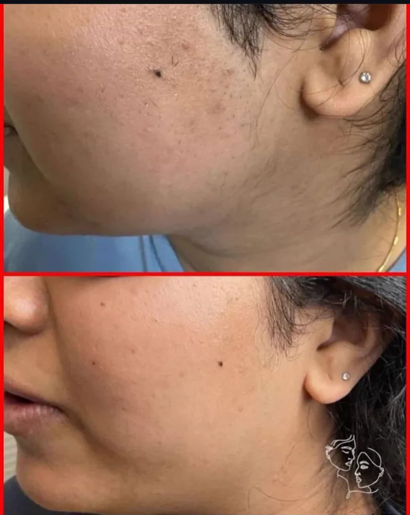 Before and after laser hair removal on the cheek and jawline at Eunoia Medi Spa, before on top and after on the bottom