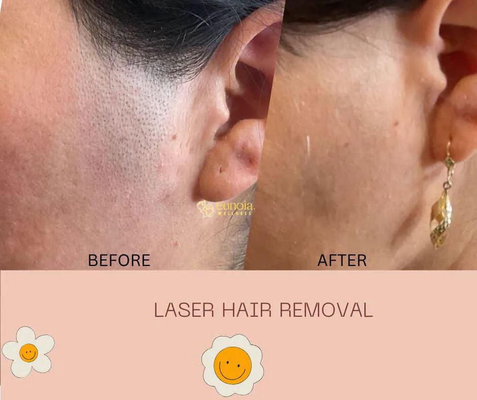 Before and after laser hair removal on the sideburn and ear area at Eunoia Medi Spa