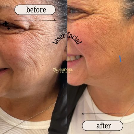 Laser facial before and after of laser facial