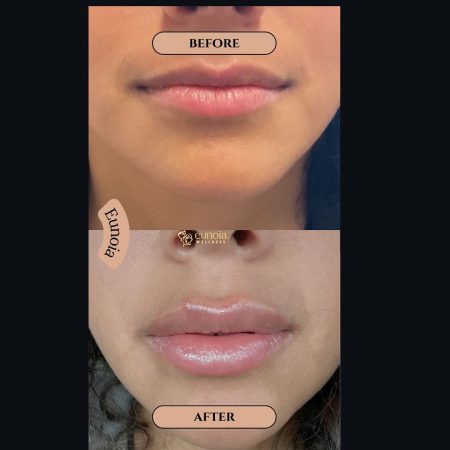 lip filler lip filler