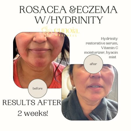 rosacea laser treatment rosacea laser treatment